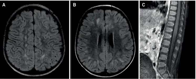 Figure 1. Brain MRI revealed white matter hyperintensities lesions in T2/fluid- attenuated inversion recovery (FLAIR) (A, B) in the  cerebral hemispheres and cerebellum, without restriction to water molecules diffusivity or gadolinium enhancement, suggesti