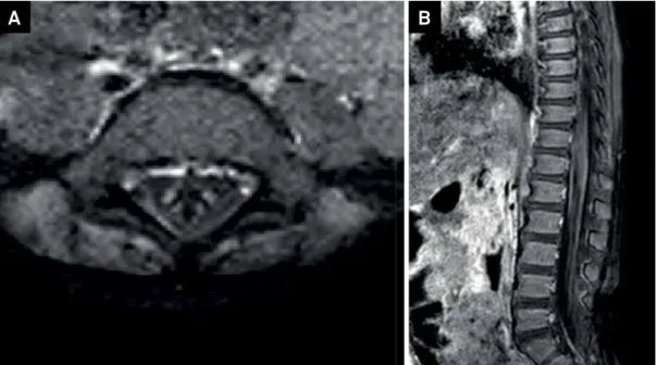 Figure 2. Follow-up MRI one week after steroids, showed partial recovery of the brain lesions; axial (A) and sagittal T1 SPIR  post-gadolinium (B), enhancement of the cauda equina roots (white arrow), compatible with Guillain-Barré Syndrome.