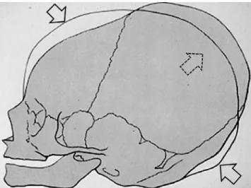 Figure 1. Illustration of skull deformation during birth with vertex  presentation. Compression of the frontal and occipital bones (full  arrows), the parietal bones are pressed out (dotted arrows).