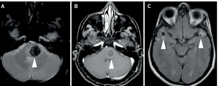 Figure 1. Axial GRE (A) and T1 GD (B) showed a focal hemorrhage compatible with a radiation-induced cavernoma in the  brainstem