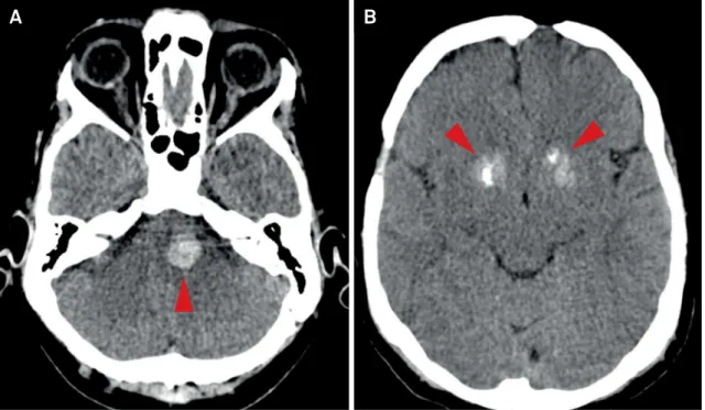 Figure 2. Axial non-contrast CT confirmed a hemorrhagic lesion in the brainstem (A) and basal ganglia calcifications (B)