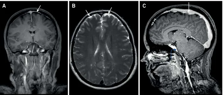 Figure 1. Coronal T1 post contrast MRI demonstrates pachymeningeal enhancement (arrows);  (B) axial T2 weighted MRI  demonstrates subdural effusions (arrows); (C) Sagittal T1-weighted post contrast demonstrates engorgement of the superior  sagittal sinus (