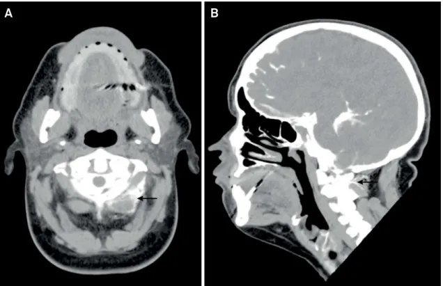 Figure 2. Sagittal and axial sections of CT-cisternography (A) axial and (B) sagittal show a C1-C2 left cerebrospinal fluid leak, with  left fluid paravertebral collection (arrows).