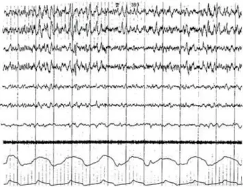 Figure 1. Polysomnographic recordings from a male subject  during non-REM sleep. The tracings from top to bottom are  EEG F3-A1, F4-A2, P3-A1, P4-A2, P3-O1, and P4-O2, EOG, EMG,  right airflow, and left airflow