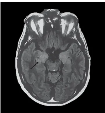 Figure 2. FLAIR sequence, brain MRI. Hippocampal  hyperintensities in anti-LG1 encephalitis.