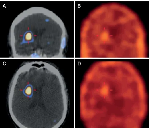 Figure 2. Scintigraphic imaging with single photon emission computed tomography shows normal  99m Tc-TRODAT uptake in the  right striatum, and absence of the radionuclide concentration on the left side.