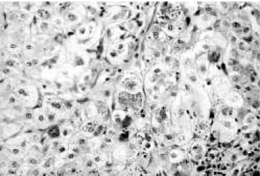 FIGURE 2 – Ethidium bromide stained polyacrylamide gel showing the profile of normal and mutant A1AT digested with the the restriction enzyme (Xmnl)