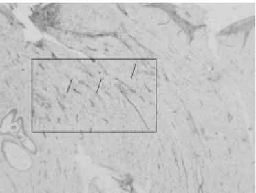 FIGURE 1 – Invasive tumour margin.  Microscopic finding of microvessels stained (arrows-brown immunoreactivity) contrasting with a blue background (Mayer  hema-toxilin)