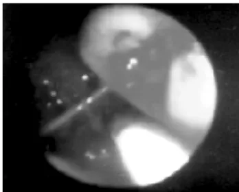FIGURE 1 – Endoscopy view of the duodenal tumor and active bleeding FIGURE 3 – Intraoperative view: duodenal tumor