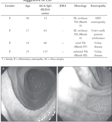 FIGURE 1 – Endoscopic view of duodenum in celiacs patients showing  a scalloping of folds (A) and mosaic pattern (B)