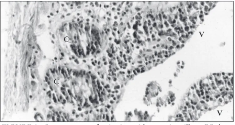 FIGURE 2 - Severe acute graft rejection with extensive villous (V) dam- dam-age  due  inflammatory  cell  infiltration  and  cryptitis  (C)  (HE, 400X)