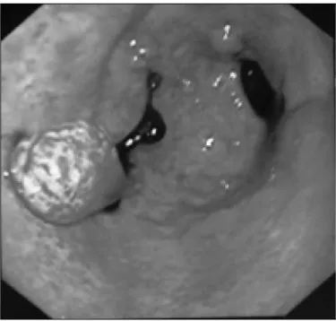 FIGURE 2  –  Illustration of treatment with APC of a patient with diffuse GAVE: A-Immediately after APC application; B-Fifteen days after fi rst ses- ses-sion; C-Disappearance of vascular ectasia after 5 sessions of APC; D-Recurrence of vascular ectasia af