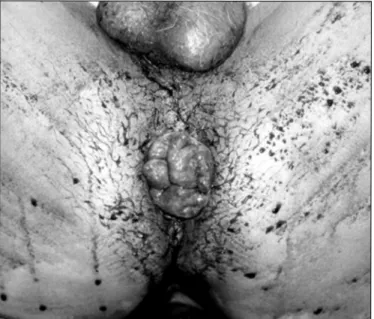 FIGURE 2 – Immediate postoperative result after stapled hemorrhoidopexy  of the same patient