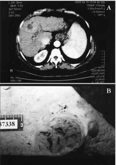 TABLE 5 – Comparison between treated and untreated patients in relation  to tumor size and tumor necrosis