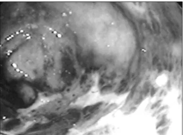 FIGURE 1. Ulcer associated to inflammatory process