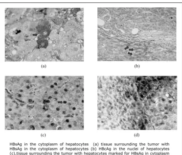 TABLE 3. Characteristics of HCV-infected patients with and without  HBV occult 