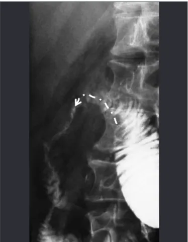 FIGURE 1. Contrasted radiography showing duodenojejunal anastomosis