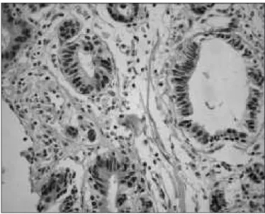 TABLE 1. Distribution of the immunostaining results according to the  intensity and distribution for p53, cyclin D1 and Bcl-2