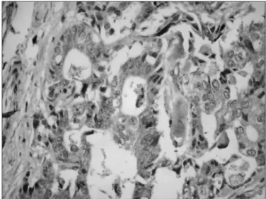 FIGURE 5. Cumulative curve of overall survival in 69 patients with EGJ  adenocarcinoma according to Cyclin D1 immunoexpression