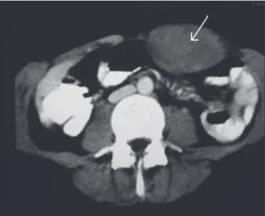 FIGURE 1. A desmoid tumor in the abdominal wall
