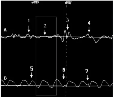 TABLE 1. Elastic resistance of the lungs and distribution of complementary  expiration for the three analyzed groups considering the swallow kind