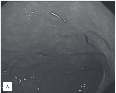 FIGURE 1C. Stoma dilation performed by advancing the serial dilator  over the guidewire