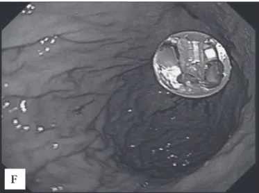 FIGURE 1F. Final endoscopic view with the low-proile tube placed