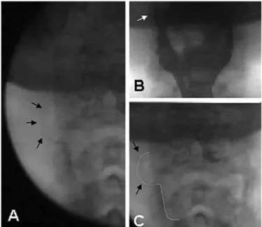 FIGURE 3. From a barium solution swallow: frame (A) shows the lateral  contour of the laryngopharynx with a discrete irregularity, probably not  ap-preciated because there is no residual volume of contrast after the swallow