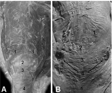 FIGURE 5. A man, without cervical extension, showing external cervical  projections of the lateral pharyngeal diverticula (arrows) evidenced by  blowing against resistance