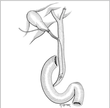 FIGURE  1.  Capture  of  calculi  with  “basket”  type  probe  introduced  through the cystic duct 