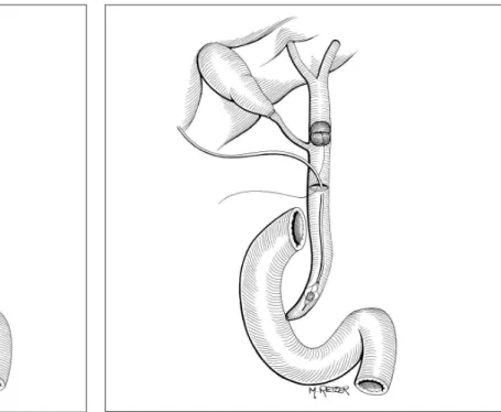 FIGURE 3C.  Mixed technique for calculi extraction through choledochotomy  – capture of calculi with “basket” type probe