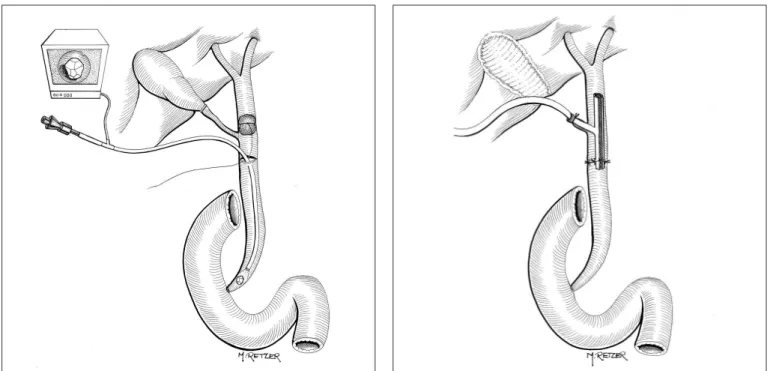 FIGURE 4.  Choledochoscopy of the distal segment FIGURE 5.  External drainage of the biliary tract through the Kehr drain