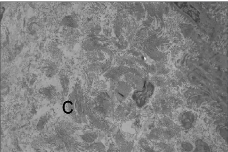 FIGURE 1. TEM images disclosing the collagen (C) proliferation responsible  for the submucosal increased thickness (x 2000)