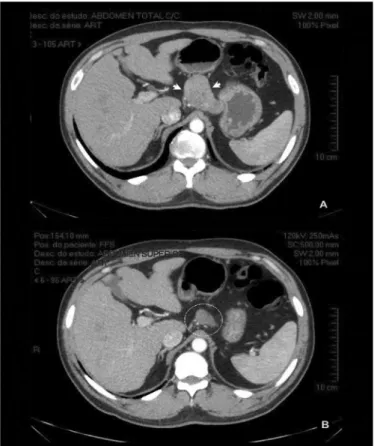 FIGURE 1. Axial contrast-enhanced CT-scan before (A) and after (B) the  neoadjuvant component of treatment with perioperative chemotherapy  (DCF – docetaxel, cisplatin and 5FU)