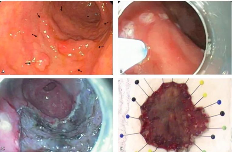 FIGURE 1A. Large gastric adenocarcinoma type IIa on the greater curvature of the antrum