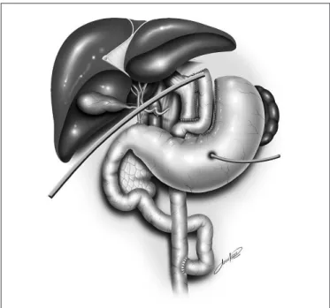 FIGURE 1. Scheme of surgery: Roux-en-Y gastric bypass surgery with  gastrotomy and silastic laminar drainage
