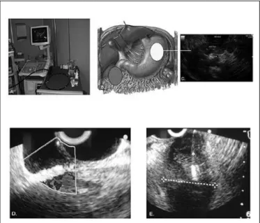 FIGURE 1. A: sectorial endoscopic ultrasound (EUS). B: anatomical loca- loca-tion of left (yellow) and right (green) kidneys