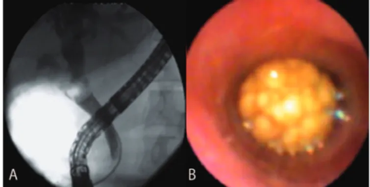 FIGURE 2. Giant bile duct stone. A: Radiologic view; B: Direct view