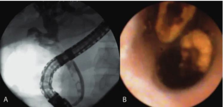TABLE 1. Choledocholitiasis analysis and performed procedures with  SpyGlass