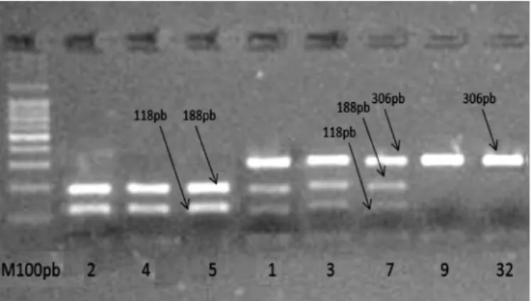 FIGURE 1. Digestion with the restriction enzyme AciI. The wild-type  G/G genotype presents two fragments of 118 and 188 bp (patients 2, 4,  and 5)
