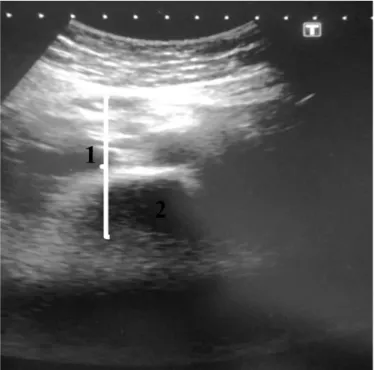 FIGURE 1. Sonographic scheme of measurements subcutaneousfat thick- thick-ness (1): subcutaneous fat thickthick-ness, (2): rectusabdominis muscle
