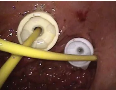 FIGURE 1.  Endoscopic view, showing a recently placed PEG drainage  tube side-by-side with a previous placed feeding PEG-J