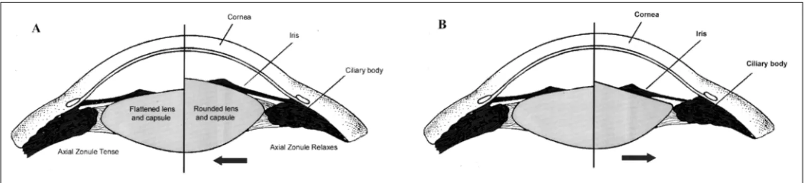 Fig. 4 - Schematic drawings showing Helmholtz’s (A) and Schachar’s (B) theories of accommodation