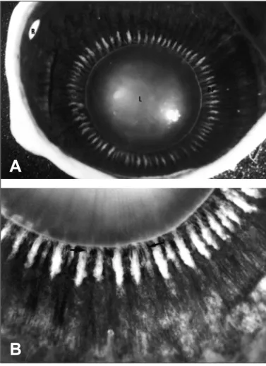 Fig. 6 - Photographs of a human globe obtained postmortem taken from an operating microscope after sectioning the globe at the equator showing the inner surface of the anterior segment from a posterior view; A