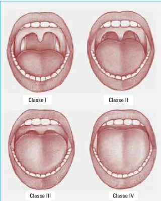 FIGURA 2 - Índice de Mallampati modificado: Classe I — visualiza-se  toda a parede posterior da orofaringe, incluindo o pólo inferior das  tonsilas palatinas; Classe II — visualiza-se parte da parede  poste-rior da orofaringe; Classe III — visualiza-se a i