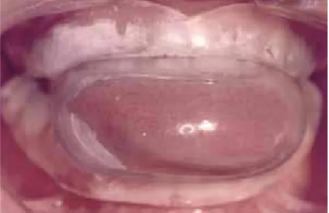 FIGURA 4 - Aparelho BRD (Brazilian Dental Appliance): aparelho reposi- reposi-cionador mandibular para tratamento de ronco e SAOS 27 .