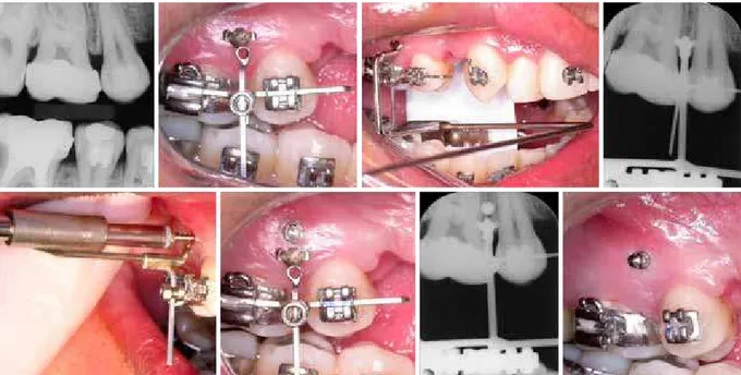 FIGURA 2 - Procedimentos para instalação dos mini-implantes utilizando o guia radiográfico-cirúrgico graduado (GRCG).