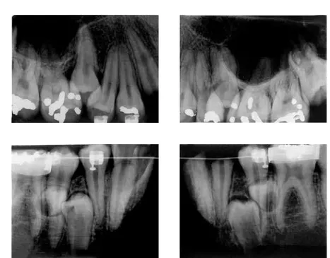 FIGURA 3 - Radiografias pós-morte, onde se observam dentes supranumerários nas arcadas dentá- dentá-rias superior e inferior, alguns braquetes e bandas nos molares inferiores.