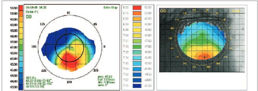 Figure 4 - A volunteer with keratoconus. We have manually edited a black circle in the EyeSys map to designate the corresponding area mapped by our system