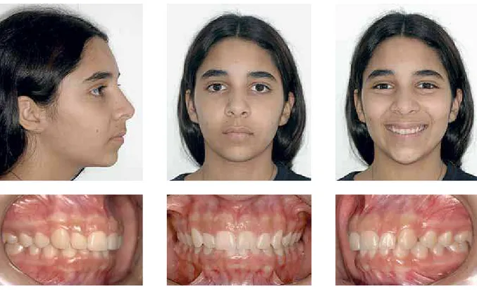 FIGURA 15 - Caso clínico 1 - aspectos faciais e dentários iniciais.